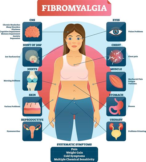 fibromialgija